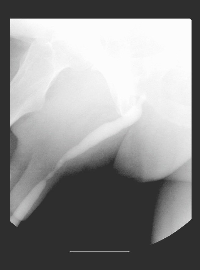 70yo man with severe LUTS and poor response to medical therapy, with significant impact on QoL.

The patient has a BMI of 38 

You have the following imaging studies 👇👇