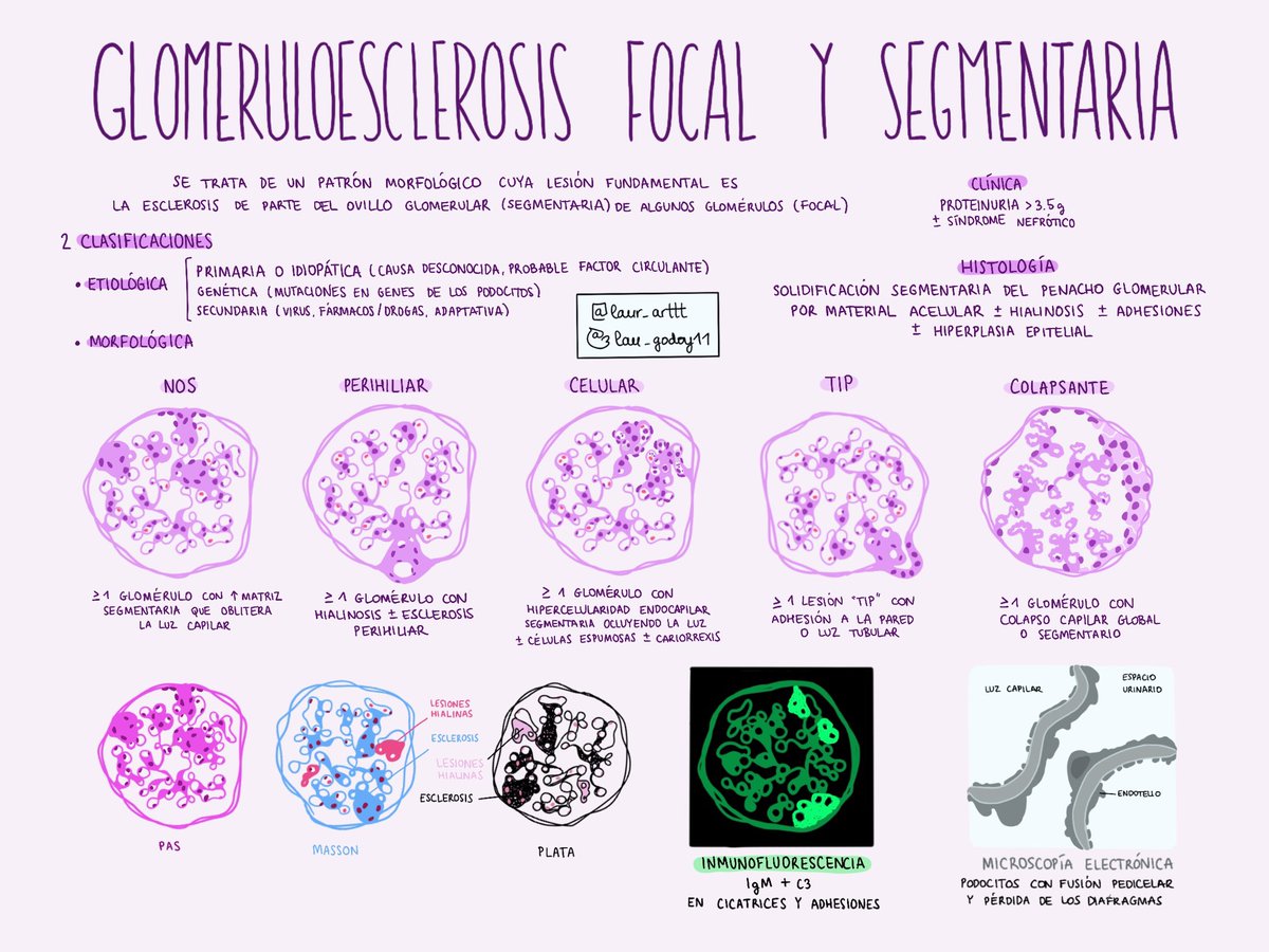 lau_godoy11's tweet photo. Glomeruloesclerosis focal y segmentaria 🌊

🔬 Afectación focaI ➡️ <50% de los glomérulos y segmentaria ➡️ <50% del glomérulo

💧Clínica: síndrome nefrótico 

🧬 Etiología: primaria/idiopática, genética o secundaria 

#pathology #PathTwitter #kidney #renalpath #pathart #medicine https://t.co/2jNbBb1VaL