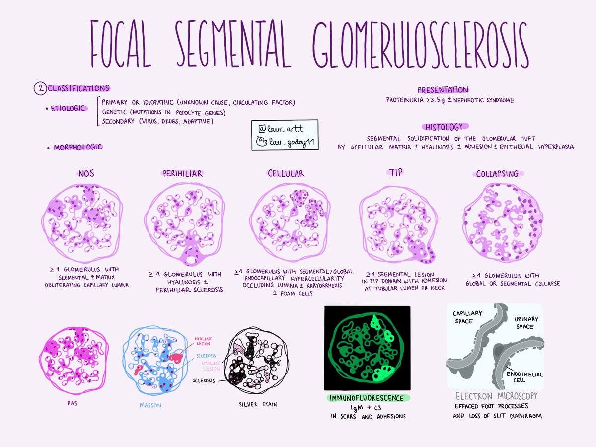 lau_godoy11's tweet photo. Glomeruloesclerosis focal y segmentaria 🌊

🔬 Afectación focaI ➡️ <50% de los glomérulos y segmentaria ➡️ <50% del glomérulo

💧Clínica: síndrome nefrótico 

🧬 Etiología: primaria/idiopática, genética o secundaria 

#pathology #PathTwitter #kidney #renalpath #pathart #medicine https://t.co/2jNbBb1VaL
