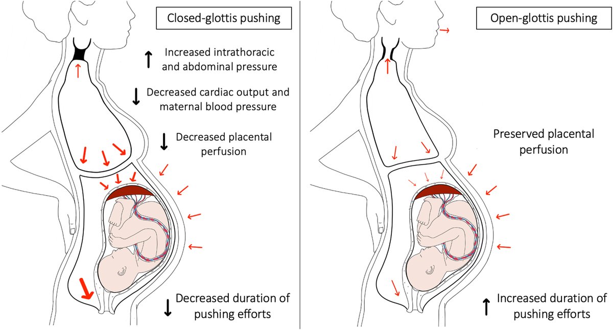 Closed- or open-glottis pushing for vaginal delivery: a planned secondary analysis of the TRAnexamic Acid for Preventing postpartum hemorrhage  - Pathophysiological hypotheses illustrating effects of pushing mode on obstetrical events ow.ly/q5nx50QJNQh