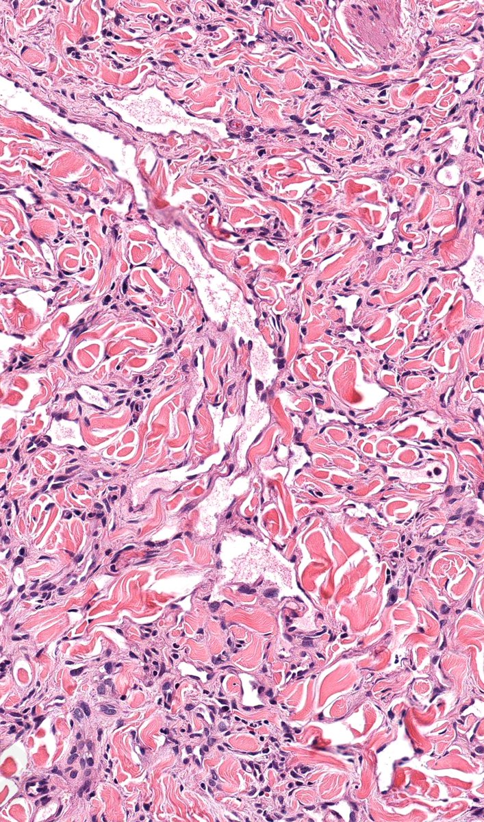 History of breast cancer and radiotherapy. 
Flesh-colored papule.
Benign or malignant?
🔬kikoxp.com/posts/3457
#BreastPath #DermPath #BSTPath #PathTwitter #Pathology