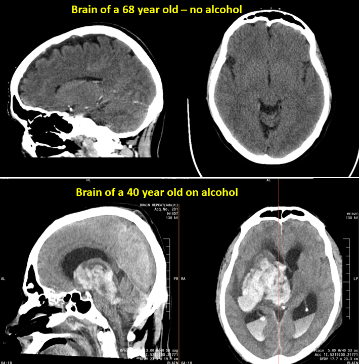 A patient decided to party last weekend and is now battling for life on the ventilator. He won't make it. See what alcohol does to the brain. It is not just the liver you need to worry about. Alcohol is a systemic poison. It damages everything in its path. The big white blotches