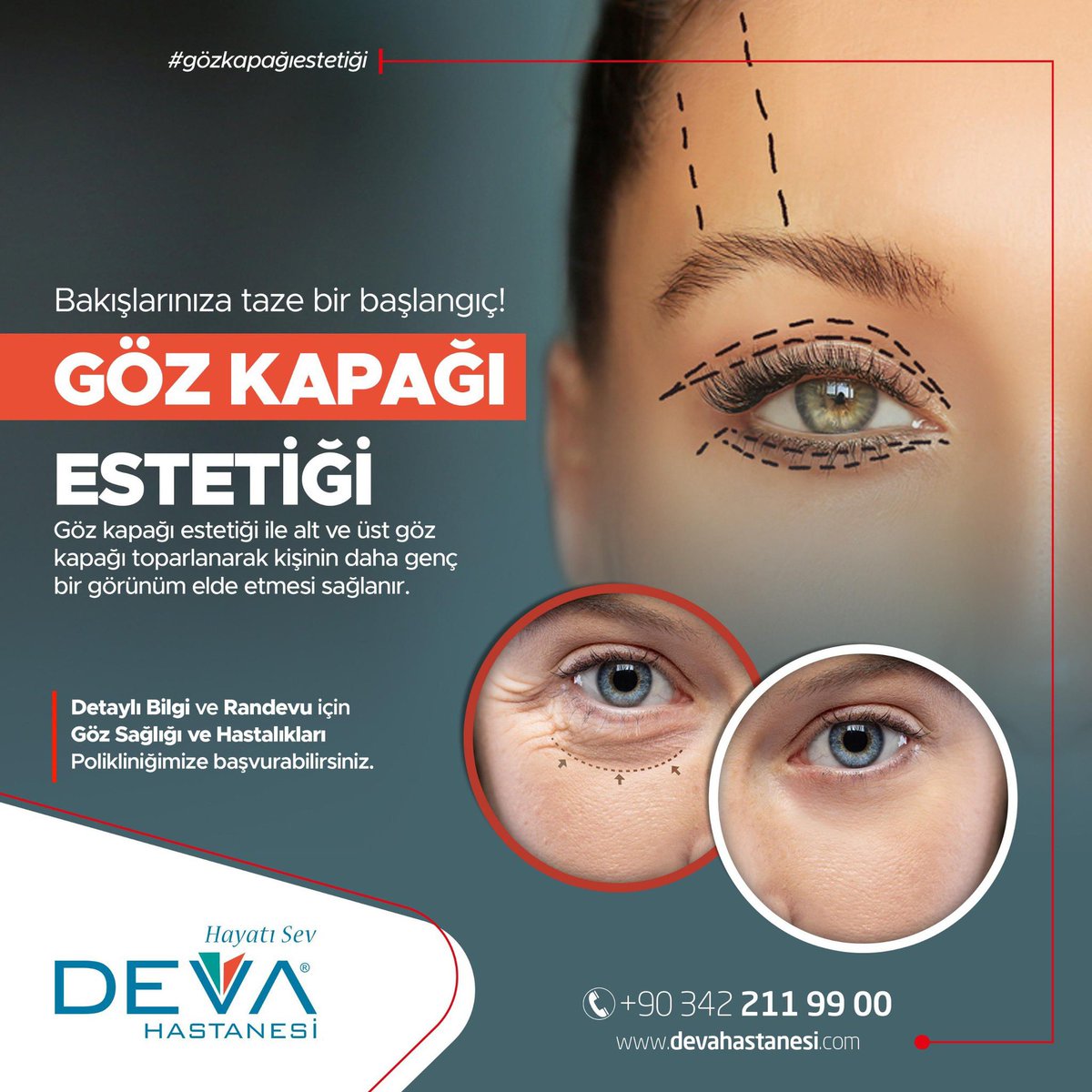 Alt ve üst göz kapağı toparlanarak bakışlarınızın enerjisi yeniden ortaya çıkıyor. Siz de daha canlı ve genç bir görünüm için bizimle iletişime geçin! 💫

#gözkapağıestetiği #devahastanesi