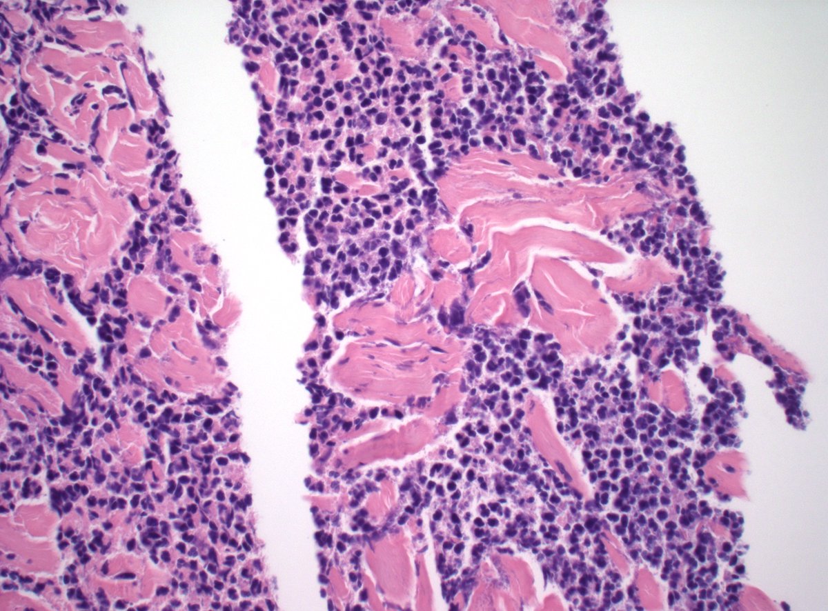This case tricked me. Deeper levels show better preserved/less degenerated areas showing neutrophils. It's a fledgling abscess!