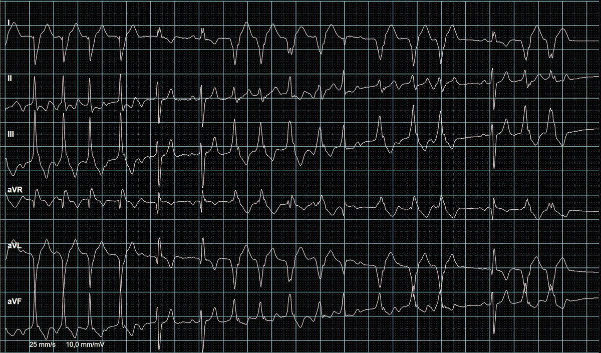 Palpitations, rhythm? <a href="/KostekMilan/">Milan Koštek</a> <a href="/ThaierT13525/">Thaier Albreizat</a> <a href="/PeterItebimien/">Itebimien Peter</a> <a href="/tbouthillet/">Tom Bouthillet</a> <a href="/EKGest/">Ecg</a> <a href="/OwnerOfALonelyH/">Aj</a> <a href="/IhabFathiSulima/">Dr Ihab Suliman</a> <a href="/DrparrayMD/">Drparray Mohammad</a> <a href="/EKGest/">Ecg</a> <a href="/AhmadGreenman/">Ahmad Greenman</a> <a href="/RobertHermanMD/">Robert Herman, MD, PhD</a> <a href="/DrRajeshG1/">Dr G Rajesh (Gopalan Nair Rajesh).</a> @drahmedmohsen <a href="/TruthinMindBody/">John W Wang</a> <a href="/ecgotaku/">Dr.トモ＠心電図オタク</a> <a href="/MubarakAlhatemi/">Mubarak Alhatemi</a> <a href="/koggelnoggel/">Jana Borucka</a>