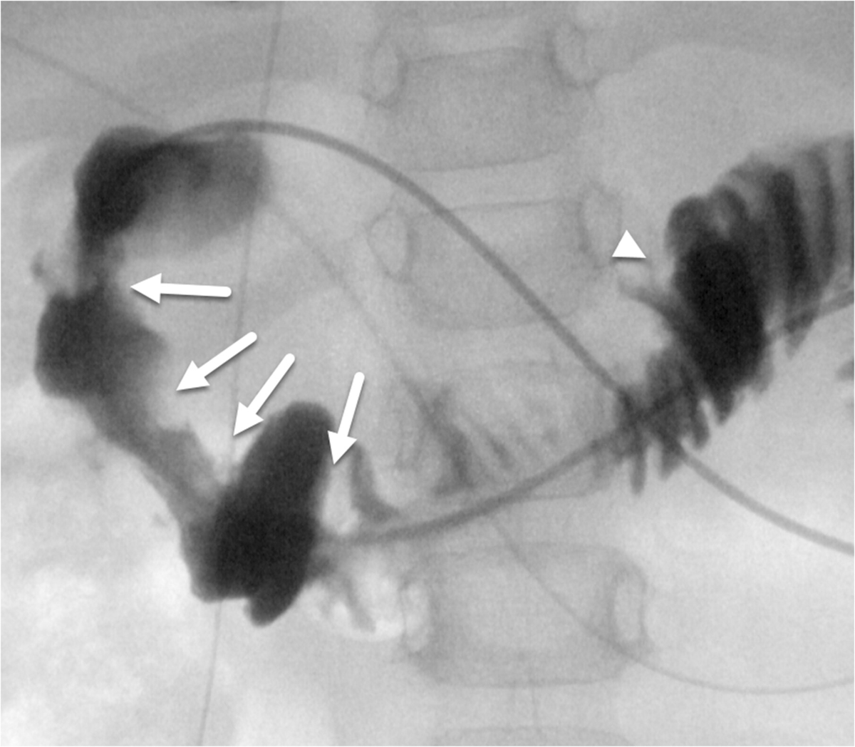 Mamula et al share the latest case report of a 32 month-old w/ multiple #duodenalwebs dx after failed gastrojejunostomy exchange successfully treated with combination #endoscopic therapy #openaccess

onlinelibrary.wiley.com/doi/full/10.10…