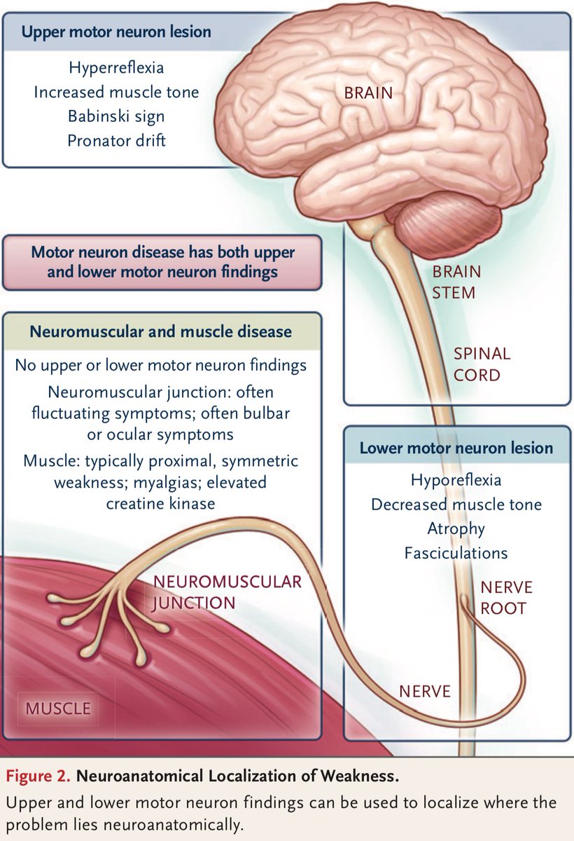 AmbrizMau's tweet photo. Localizaciones neuroanatómicas de la debilidad:

N Engl J Med 2024;391:1441-50. https://t.co/2hZfW4lqYP