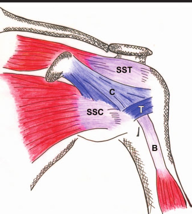 Rotator Interval (RI)

RI: important for shoulder stability/function

Anatomic boundaries
✅B: long head of biceps brachii tendon
✅C: coracohumeral ligament
✅SSC: subscapularis tendon
✅SST: supraspinatus tendon
✅T: transverse humeral ligament
#shoulder
pubs.rsna.org/doi/10.1148/ra…