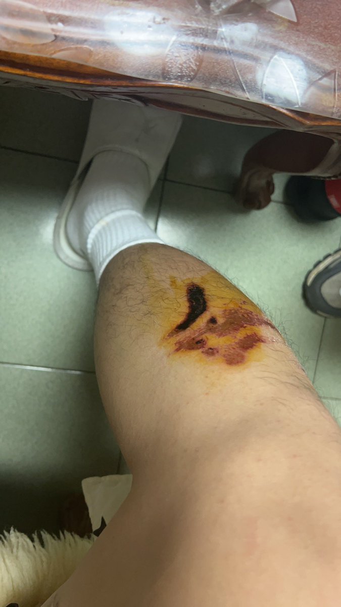 过期10多年的碘伏我居然还在这抹伤口……