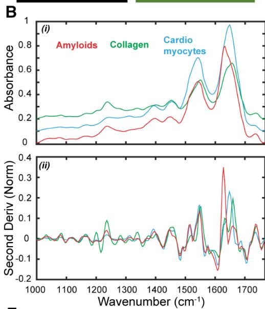 Circulation (@circaha) on Twitter photo Using infrared spectroscopic images and #AI, can we detect and type cardiac amyloid? <a href="/joemaleszewski/">Joe Maleszewski, MD</a> ahajournals.org/doi/full/10.11… Using infrared spectroscopic images and #AI, can we detect and type cardiac amyloid? <a href="/joemaleszewski/">Joe Maleszewski, MD</a> ahajournals.org/doi/full/10.11…