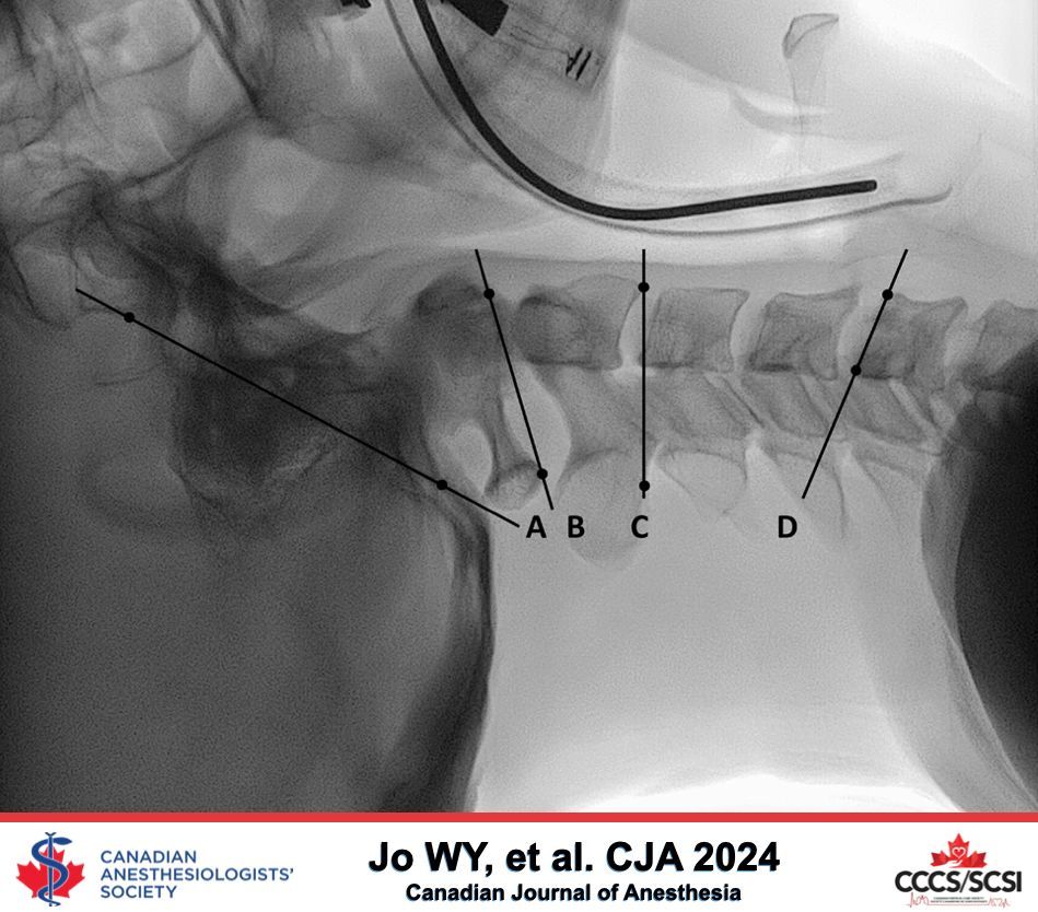 CJA_Journal's tweet photo. Cervical spine motion during videolaryngoscopic intubation using a Macintosh-style blade with and without the anterior piece of a cervical collar: a randomized controlled trial - Canadian Journal of Anesthesia #CJA #CJA2024 #Anesthesia #Anesthesiology https://t.co/PeJl8cLCw5 https://t.co/28sCzRy1op