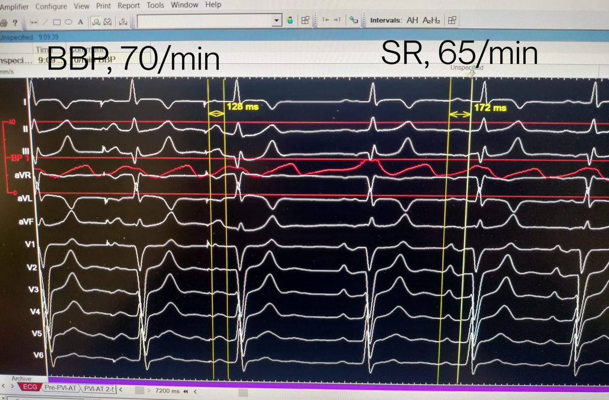 Kevin Vernooy (@kvernooy) on Twitter photo Studying the effects of Bachmann bundle pacing.
Curious what this will bring us in the coming years.
<a href="/Dominik_Linz/">Dominik Linz</a> <a href="/HisLBBPacing/">Conduction System Pacing</a> <a href="/lusty63/">Dan Lustgarten MDPhD</a> <a href="/Dr_JozaEP/">Jacqueline Joza</a> <a href="/V_Mardigyan/">Vartan Mardigyan</a> <a href="/Dr_JozaEP/">Jacqueline Joza</a> <a href="/purerfellner/">Dr. Helmut Pürerfellner</a> <a href="/HaranBurri/">Haran Burri</a> <a href="/DoVerhaert/">Dominique Verhaert</a> <a href="/enes_elvin/">Enes Elvin Gul, MD, FESC, FEHRA</a> <a href="/Marek_Jastrz_EP/">Marek Jastrzębski</a> Studying the effects of Bachmann bundle pacing.
Curious what this will bring us in the coming years.
<a href="/Dominik_Linz/">Dominik Linz</a> <a href="/HisLBBPacing/">Conduction System Pacing</a> <a href="/lusty63/">Dan Lustgarten MDPhD</a> <a href="/Dr_JozaEP/">Jacqueline Joza</a> <a href="/V_Mardigyan/">Vartan Mardigyan</a> <a href="/Dr_JozaEP/">Jacqueline Joza</a> <a href="/purerfellner/">Dr. Helmut Pürerfellner</a> <a href="/HaranBurri/">Haran Burri</a> <a href="/DoVerhaert/">Dominique Verhaert</a> <a href="/enes_elvin/">Enes Elvin Gul, MD, FESC, FEHRA</a> <a href="/Marek_Jastrz_EP/">Marek Jastrzębski</a>