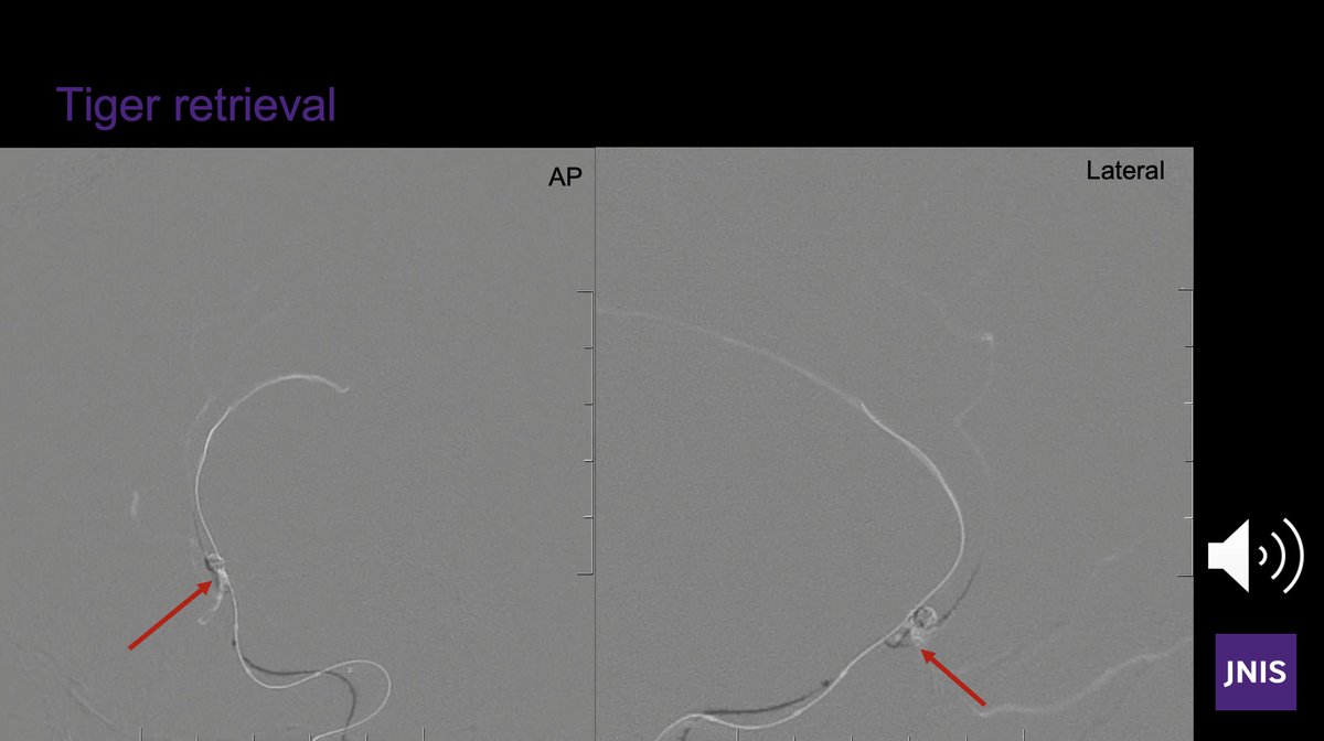 Errant coils are a challenging intraprocedural complication.  We describe the use of the Tigertriever 13 from <a href="/Rapid__Medical/">Rapid Medical</a> which fits through 0.013–0.0165  coiling catheters negating the need to upsize materials mid procedure 💪jnis.bmj.com/content/early/… <a href="/PascalMosimann/">🇨🇦 Pascal Mosimann</a> <a href="/UofT/">University of Toronto</a>