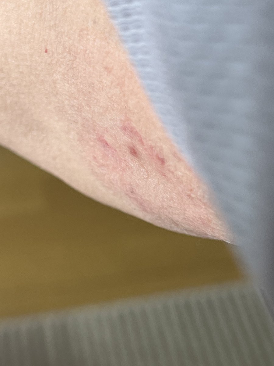 yui_evangelion's tweet image. #DexcomG7
#CGM
#1型糖尿病

リブレだったと思うけど、設置するのが怖い。
という投稿がありました。

私はDexcomG7なんだけど、
外す時がものすごく痛い😣
跡も残っています。