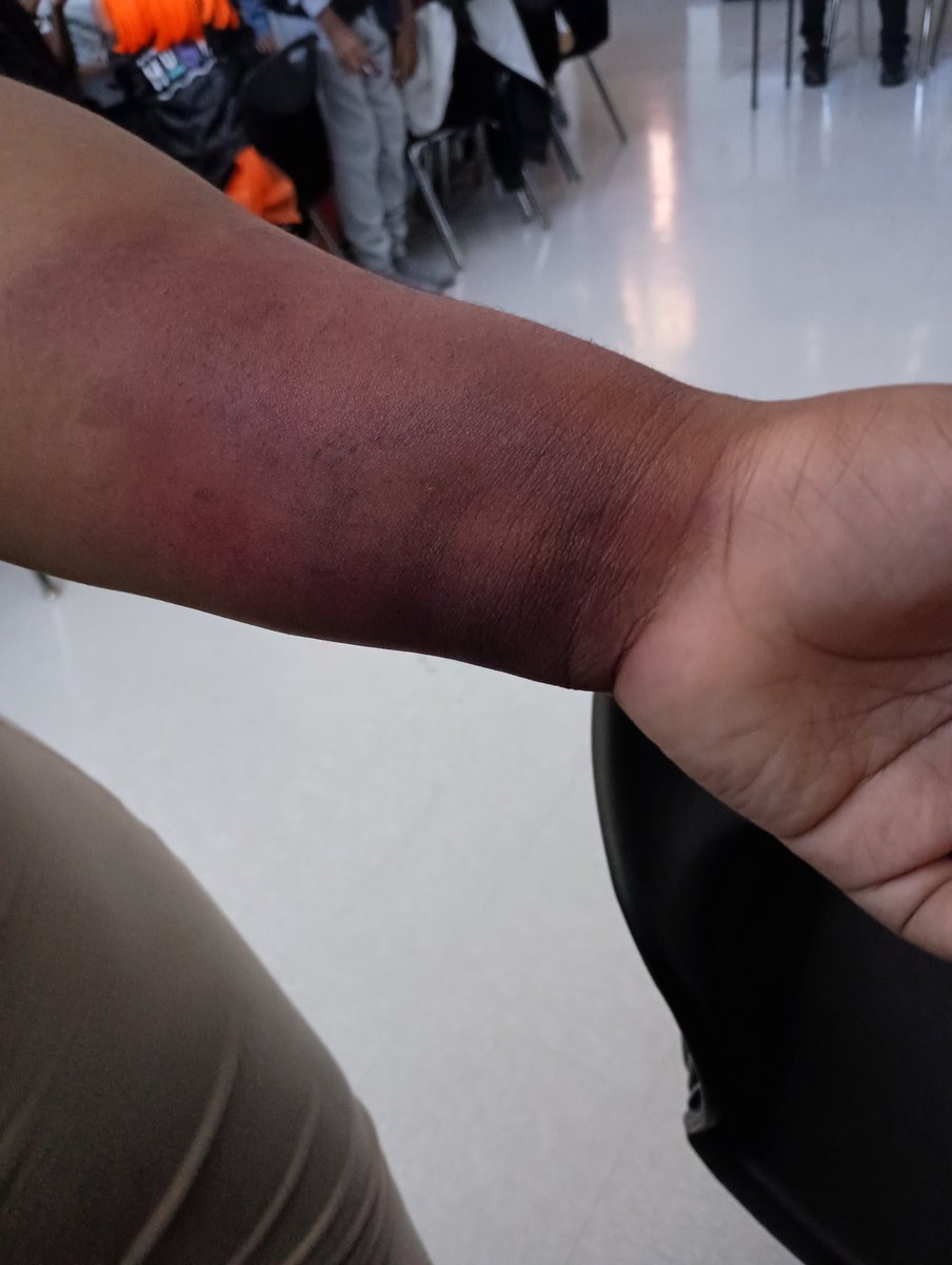 drama_thomas's tweet photo. My students doing special effects makeup. This was bruised arm day https://t.co/eIDDd71zOd