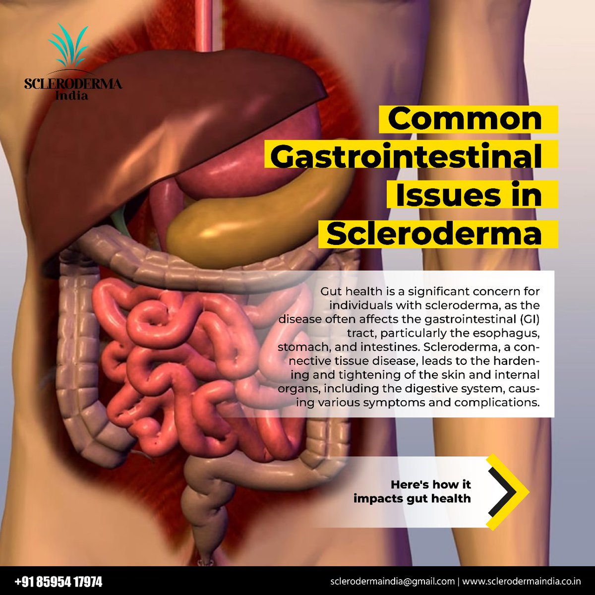 ScleroIndia's tweet image. Common gastrointestinal issues in scleroderma. 

#SclerodermaIndia #SystemicScleroderma  #GITract #GutHealth #chronicillness #AutoImmuneDisease