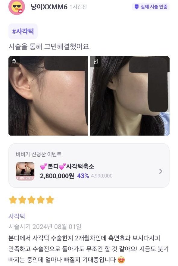 側面とても満足しています。手術前に戻っても絶対にボンディでまた手術すると思います｡今もむくみが取れてるところなんですけど、これからもどれくらい取れるか期待してます♡

#形成外科 #皮膚科 #輪郭成形 #輪郭手術  #頬骨手術 #エラ削り #あごの手術