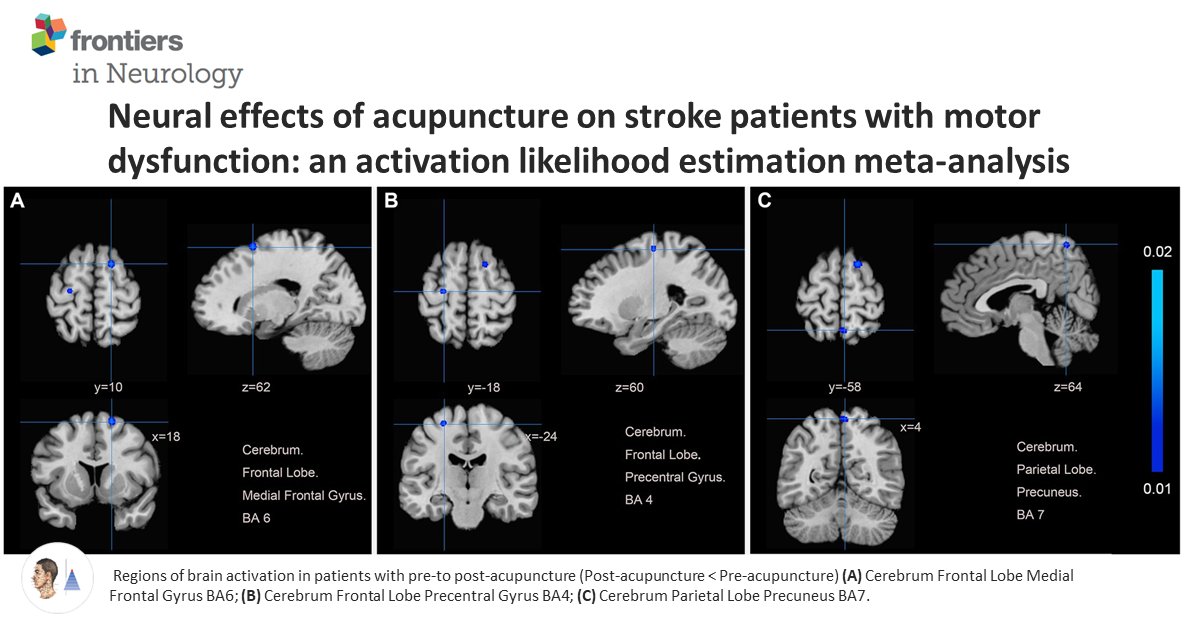 🔷Méta-analyse ALE 🇨🇳
📰Front Neurol
AVC. Méta-analyse d’estimation de la probabilité d’activation (ALE) [14 études en IRMf]. Identification des régions cérébrales spécifiques impliquées dans la récupération motrice après traitement par acupuncture.

pubmed.ncbi.nlm.nih.gov/39385820/🔓
