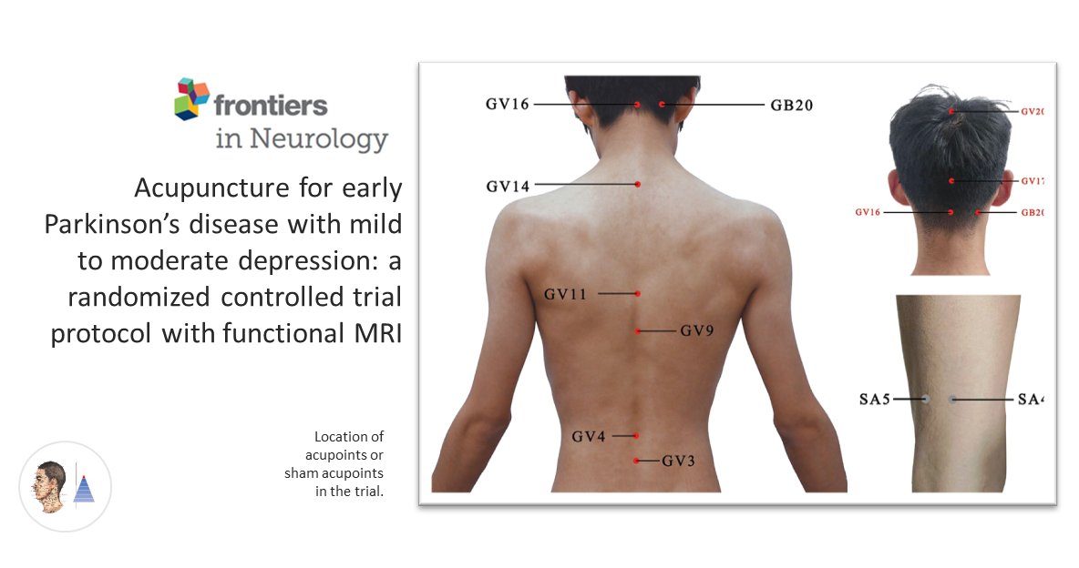 🔀Essai contrôlé randomisé 🇨🇳
📰Front Neurol
#Dépression du #Parkinson à un stade précoce. Protocole d’un essai  acupuncture [A] 𝑣𝑠 fausse [A] avec évaluation sur l'échelle d’Hamilton de la dépression (HDRS-17) et imagerie cérébrale (IRMf).

pubmed.ncbi.nlm.nih.gov/39430584/🔓
