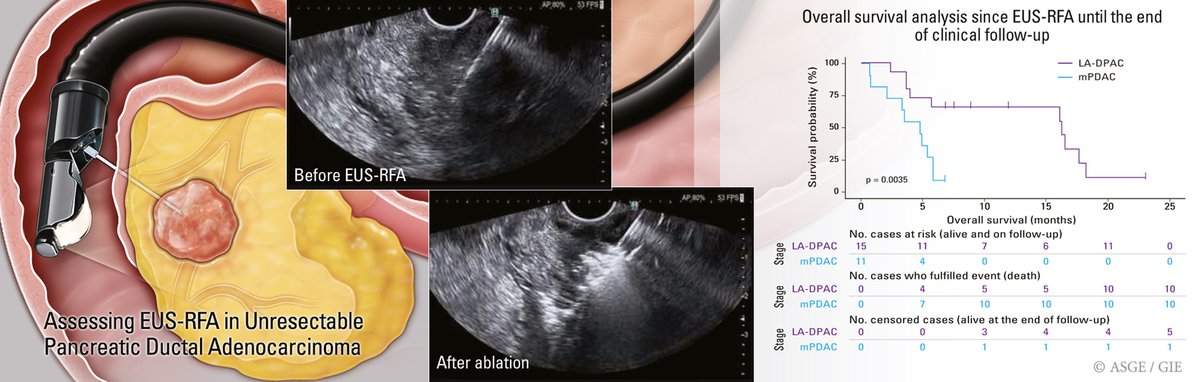 EUSRA™ : Advancing EUS-RFA - A Breakthrough in Treating Unresectable Pancreatic Cancer

"EUS-RFA for the treatment of pancreatic adenocarcinoma is a minimally invasive and safe technique" 

Read the Full study here - tinyurl.com/2dutu9xa

#ImprovingLives #GITwitter #EUSRFA