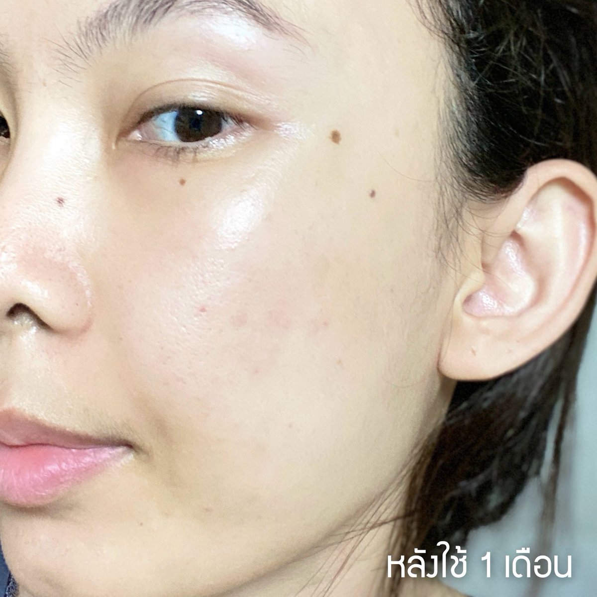 พลีชีพแพ้ครีมหน้าแหก!! ตอนนั้นที่เราแพ้คือหนักมากก จินตนาการคือสิวอักเสบซ้อนสิวอักเสบอีกทีอะ คือแสบหน้า เจ็บสิวมากกก แต่!! อิฉันหน้าดีขึ้นได้เพราะ 2 ตัวนี้ +การกดสิวและมอยส์เนื้อเจลจริงๆจ่ะ แต่ส่วนตัวคิดว่าหลักๆ คือ 2 ตัวของ Eucerin เพราะเห็นผลตั้งแต่ครั้งแรกที่ทาเลย ทาตอนนอนตื่นเช้ามาสิวมันแห้งขึ้น ใช้ต่อเนื่อง สิวค่อยๆแห้งหลุดแล้วไม่ขึ้นซ้ำ แล้วนี่ป้ายยามาตลอดกับ Eucerin ไลน์อัพ 
Pro Acne Solution ว่าสำหรับคนเป็นสิวมันเริ่ดดดดมากๆ  ลดสิว ลดรอยสิว คุมมันได้ดีสุดๆๆ ส่วนเรื่องรอยมีมาส์กหน้าบ่อยๆเพิ่ม ร่วมกับทานวิตามินซีกับคอลลาเจนเสริม เลยหายไวมากกก 
#EucerinThailand #จบทุกสิวและรอยสิวซ้ำซาก #EucerinTripleEffectSerum #EucerinGeltoFoam #สิว 
#รอยสิว