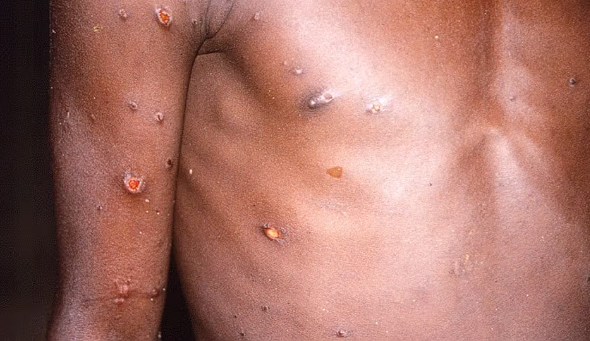 firehorse249791's tweet photo. [Mpox] Germany identifies its first case of clade 1b mpox, becoming 5th country outside Africa linked to outbreak > https://t.co/z5qE8VOiXj #ClimateEmergency #ZoonoticDisease #Mpox #Monkeypox #Clade1 #Clade1b #Africa #Congo #Kenya #Sweden #Thailand #Germany #US #Global #Worldwide https://t.co/P3HahS3plY