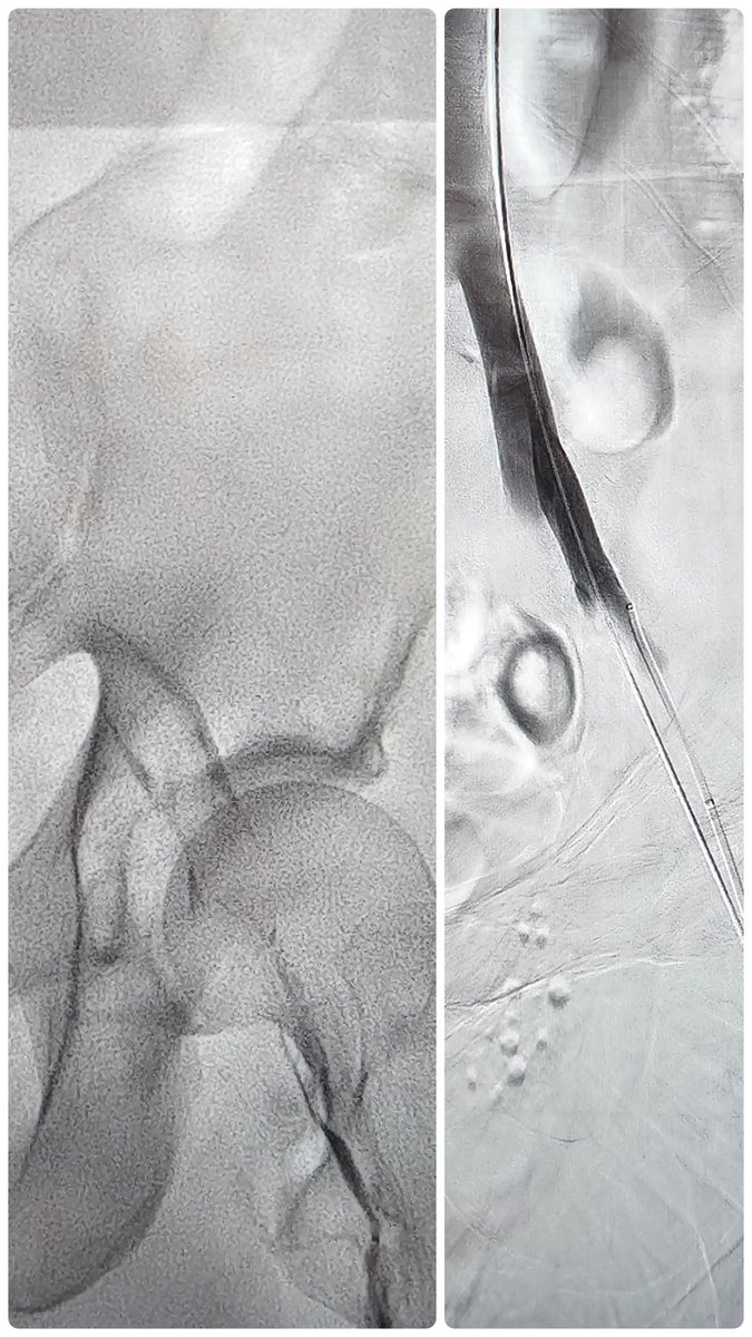Shuo (Chris) Li (@vir_li) on Twitter photo Chronic DVT to the EIV with pain and swelling. Problem solved in 45 minutes and patient sx resolved in 24 hours. #DVT #irad <a href="/SIRspecialists/">Society of Interventional Radiology</a> Chronic DVT to the EIV with pain and swelling. Problem solved in 45 minutes and patient sx resolved in 24 hours. #DVT #irad <a href="/SIRspecialists/">Society of Interventional Radiology</a>