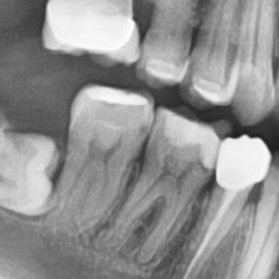 dentist_amar617's tweet image. Replasment of old resotraion with recurrent  caries in mesial side of #46
Pul exposet partialy, MTA plaserd thrn filled with composite
Finished and polished 
#saveatooth  #resotivetratment
The final result in next post