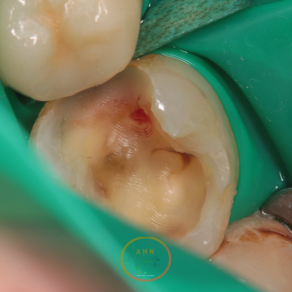 dentist_amar617's tweet image. Replasment of old resotraion with recurrent  caries in mesial side of #46
Pul exposet partialy, MTA plaserd thrn filled with composite
Finished and polished 
#saveatooth  #resotivetratment
The final result in next post
