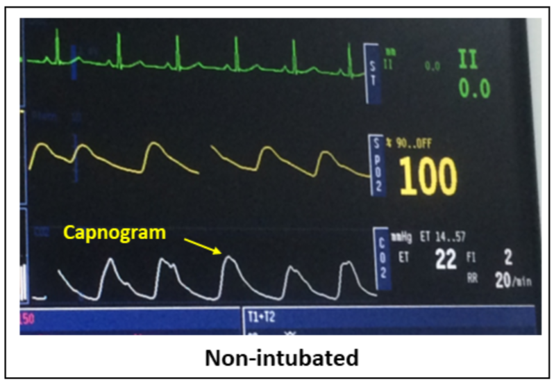 wfsaorg's tweet photo. 📢 New tutorial released - ATOTW 534: Capnography in the Nonintubated Patient https://t.co/dfYMdFgOW8

Capnography can be used in non-intubated patients undergoing sedation, and in those at risk for airway compromise. Combined with oxygen delivery through masks or nasal prongs; it improves patient safety by detecting ventilatory compromise much earlier than pulse oximetry
#anaesthesia #anesthesiology #anesthesia