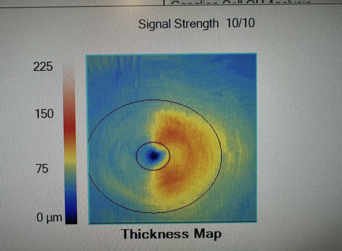 The ability of the Zeiss Cirrus OCT’s ganglion cell analysis to pick up retrograde macular atrophy after an occipital stroke will never cease to amaze me.