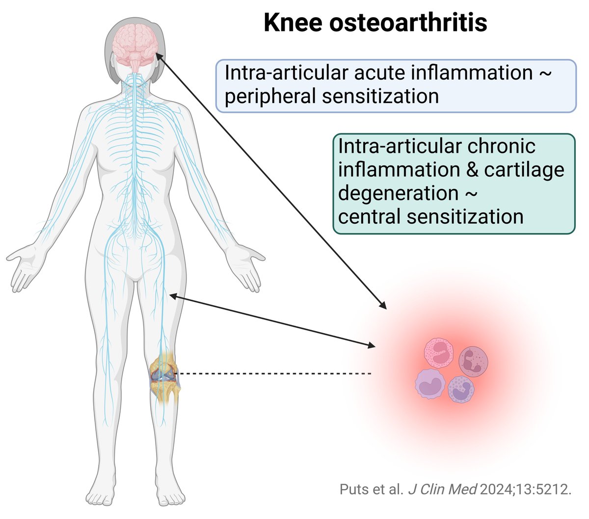 JoNijsBE's tweet image. Dear X Friends, intra-articular biomarkers of acute #inflammation relate to peripheral #sensitization, while intra-articular biomarkers of #cartilage degeneration &amp;amp; chronic inflammation relate to central sensitization in #knee #osteoarthritis: 🔓tinyurl.com/mpez56ej