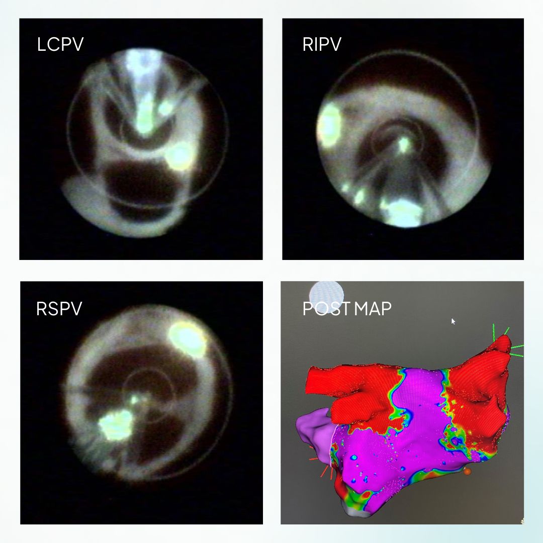 Excited to share a recent case from Rush University Medical Center! Dr. Henry Huang used HeartLight X3’s endoscope and ultra-compliant balloon to achieve successful WACA lines and isolate all pulmonary veins, including a large LCPV.

Check out the endoscope views below!

#epeeps