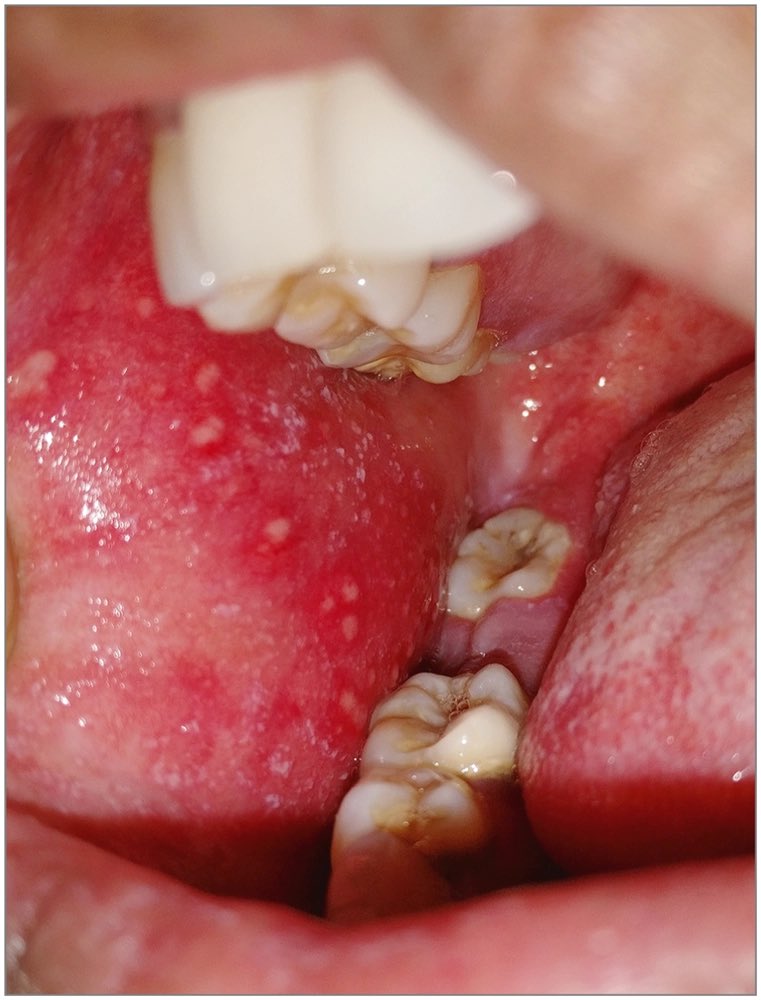 DrMedica_13's tweet photo. #Clinical_Case✨
Patient has h/o #Cough #Coryza #conjunctivitis
And these spots in his oral cavity!
Name these spots?
What is your “Diagnosis”?
#Diagnosis #MRCP #Infections #MedEe https://t.co/k6LM1kkPY9