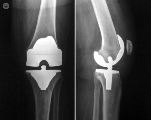 Noticias fisiociencia 23/10/2024

pubmed.ncbi.nlm.nih.gov/39434384/

El tratamiento de fisioterapia en pacientes con artroplastia de rodilla intervenidos el mismo dia: 

💚tienen una probabilidad de ser dados de alta en unas 24 horas. 
💚  mayor éxito en la marcha.
