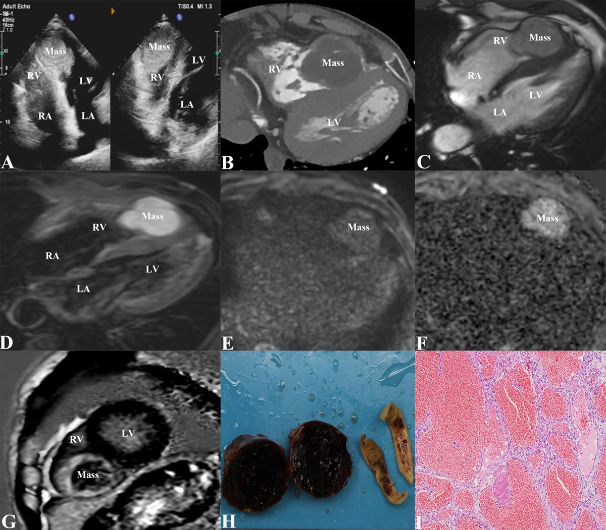 Hellenic Journal of Cardiology (@hjcardiology) on Twitter photo Can multimodality imaging help diagnose rare #cardiactumors? Check the #ImageOfTheMonth featuring a case of giant cavernous #hemangioma in the RV, diagnosed using ECHO, CCT, and CMR
bit.ly/HJC_tumor
<a href="/hjc_ed/">HJC Editor-in-Chief</a> <a href="/zhengliumdpumc/">Zheng Liu MD 刘铮</a> #echoFirst #yesCCT #whyCMR #Cardiacimaging. Can multimodality imaging help diagnose rare #cardiactumors? Check the #ImageOfTheMonth featuring a case of giant cavernous #hemangioma in the RV, diagnosed using ECHO, CCT, and CMR
bit.ly/HJC_tumor
<a href="/hjc_ed/">HJC Editor-in-Chief</a> <a href="/zhengliumdpumc/">Zheng Liu MD 刘铮</a> #echoFirst #yesCCT #whyCMR #Cardiacimaging.