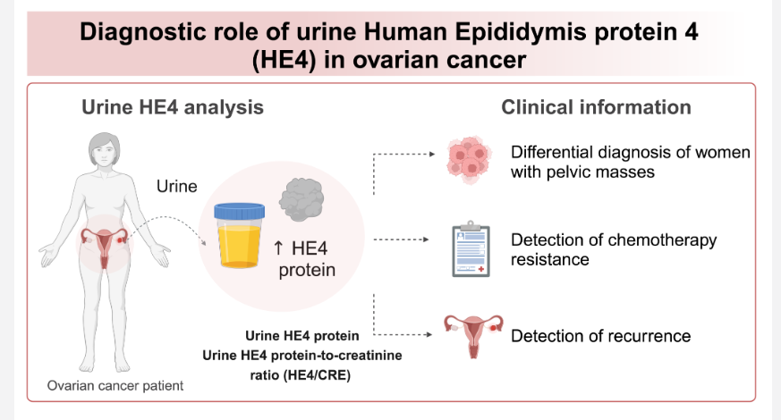 AntonijaHanzek's tweet photo. Human epididymis protein 4 (HE4), a protein overexpressed in ovarian cancer is present in urine and could be used as a promising, non-invasive diagnostic tool for the detection and monitoring this disease. Read more here 🧪🔬  https://t.co/pfrEIP6aWJ https://t.co/G3DncXLPyW
