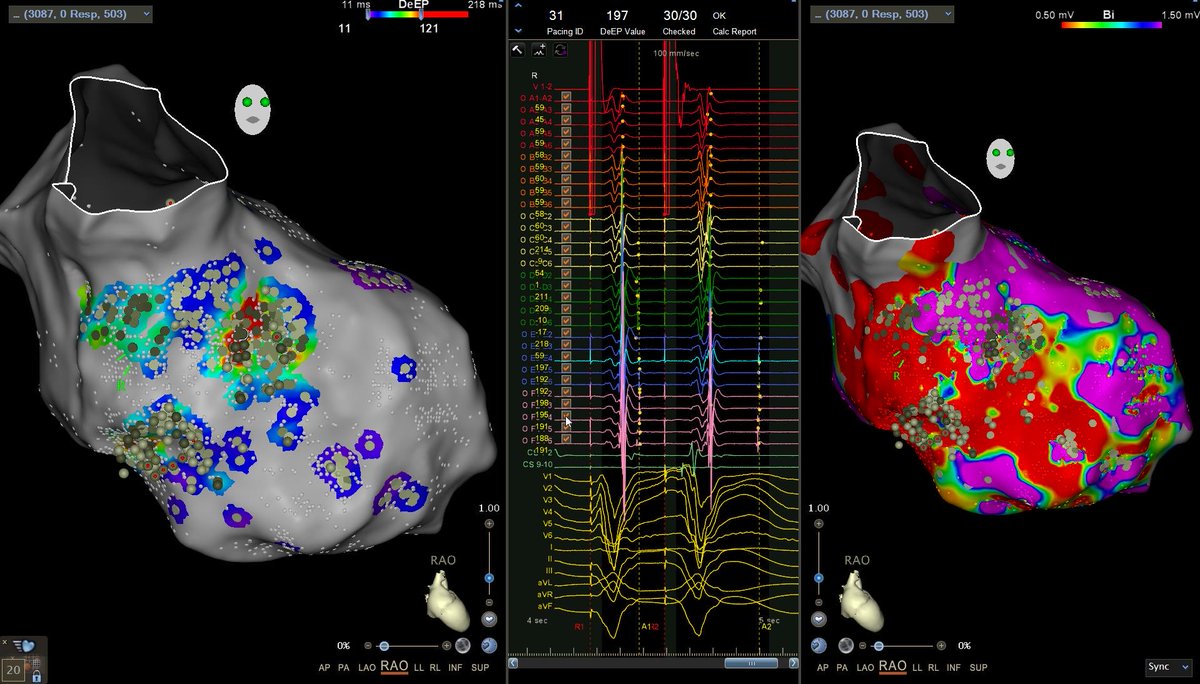 NickJackson193's tweet photo. First cases in Australia and using Optrell with the automated DeEP algorithm. DeEP localized beautifully with the common isthmus for a number of VTs and nil inducible following DeEP ablation. https://t.co/93ippprSSH