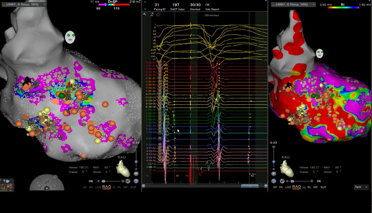 NickJackson193's tweet photo. First cases in Australia and using Optrell with the automated DeEP algorithm. DeEP localized beautifully with the common isthmus for a number of VTs and nil inducible following DeEP ablation. https://t.co/93ippprSSH