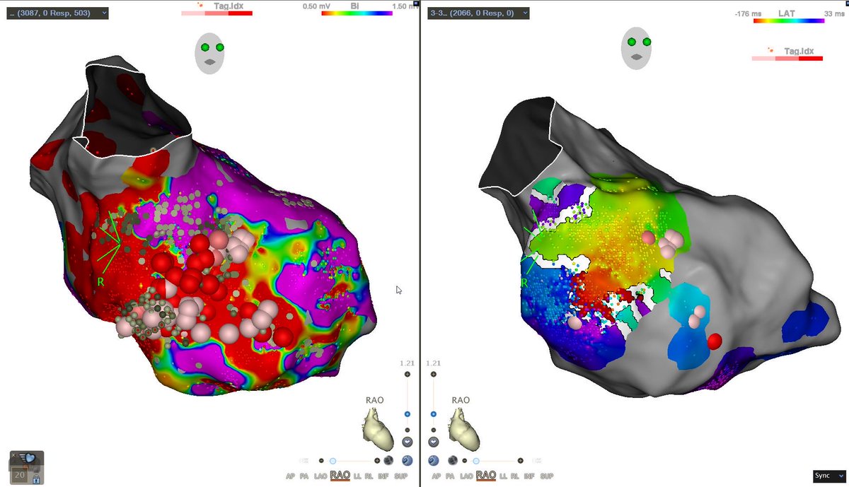 First cases in Australia and using Optrell with the automated DeEP algorithm. DeEP localized beautifully with the common isthmus for a number of VTs and nil inducible following DeEP ablation.