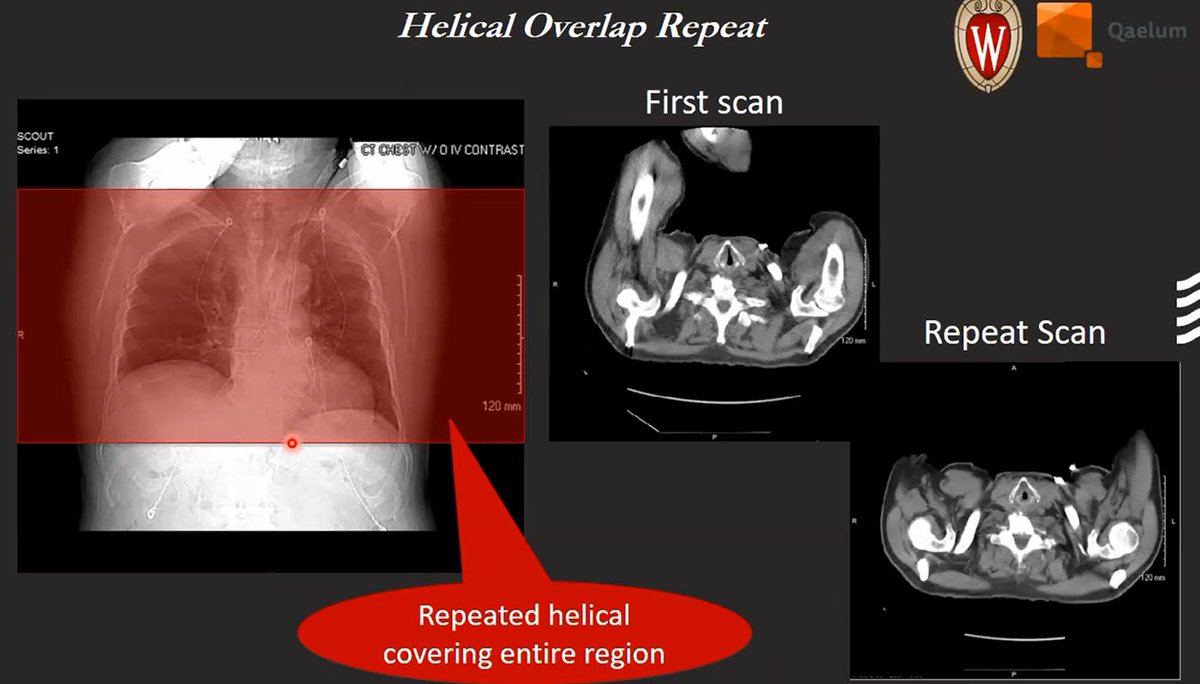 qaelumNV's tweet image. Check out the recorded webinar: a source of radiation dose doubling and wasted scan time by Dr. Tim Szczykutowicz from the University of Wisconsin Madison on the pressing issue of unnecessary repeated scans in CT imaging. ow.ly/EGQP50H8h4W
  #CTrepeat