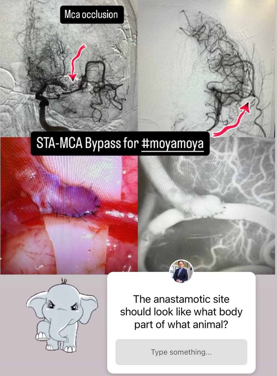 James K. Liu, MD (@skullbasemd) on Twitter photo When the brain is thirsting for flow, direct STA-MCA bypass provides an immediate solution. #bypass #moyamoya #directrevascularization #edasisnotbypass <a href="/NeuroSurgeryNJ/">Neurosurgeons of NJ</a> <a href="/CBMCNJ/">Cooperman Barnabas Medical Center</a> <a href="/moyamoyafdn/">Moyamoya Foundation</a>
Q: the anastamotic site should look like what body part of what animal?
Post your answer When the brain is thirsting for flow, direct STA-MCA bypass provides an immediate solution. #bypass #moyamoya #directrevascularization #edasisnotbypass <a href="/NeuroSurgeryNJ/">Neurosurgeons of NJ</a> <a href="/CBMCNJ/">Cooperman Barnabas Medical Center</a> <a href="/moyamoyafdn/">Moyamoya Foundation</a>
Q: the anastamotic site should look like what body part of what animal?
Post your answer