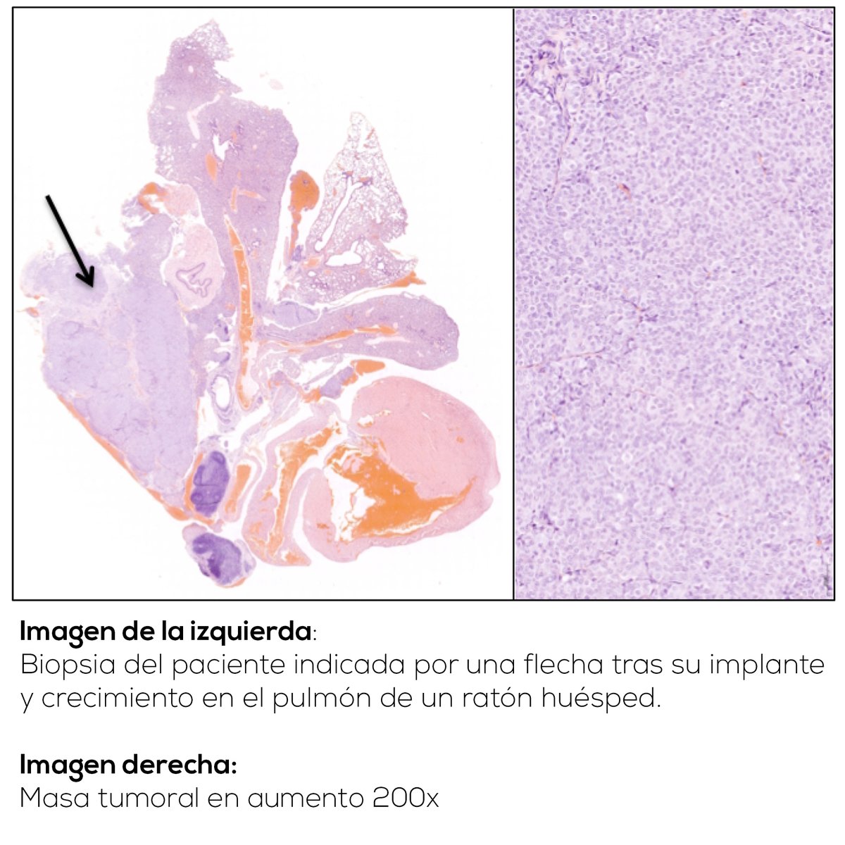 ciccancer's tweet photo. Nuevos abordajes farmacológicos en cáncer de pulmón resistente a tratamiento

https://t.co/eVtaEJQ7Fq https://t.co/V7wSXeJYlI