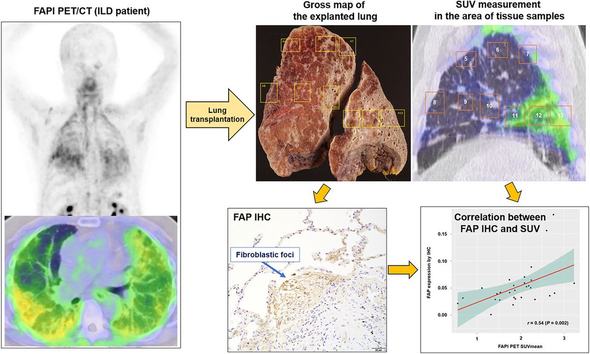 Does FAPI PET uptake reflect pathologic FAP expression in patients with interstitial lung diseases? Spoiler alert: The answer is yes.  ow.ly/m8y350TG65j

#NuclearMedicine #PETscan #LungDisease <a href="/CalaisJeremie/">Jeremie Calais</a> <a href="/masatoshihotta/">Masatoshi Hotta</a> <a href="/samweigtmd/">Sam Weigt, MD</a> <a href="/CzerninJohannes/">Johannes Czernin</a>