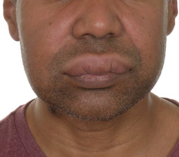 ZainKhalpey's tweet photo. Appearance of the face and mouth in a 45 year old with chronic diarrhoea.
What’s the diagnosis?
#MedTwitter #NiacinDeficiency #ChronicDiarrhea https://t.co/V4SmCQfkqL
