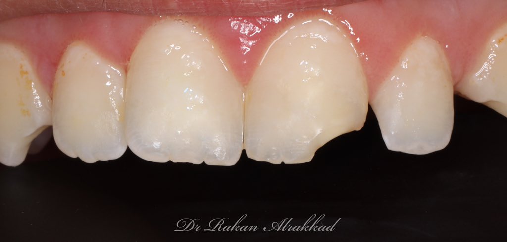 Class lV restoration of #21 
حشوة تجميلية لسن امامي مكسور ✨