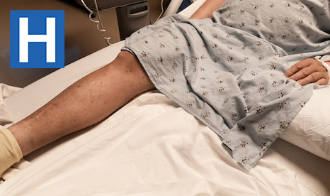 hospitalnewscom's tweet image. Improved continuity of care protective for persons with lower-extremity amputation.
ow.ly/uIkL50TRIm9
#AmputationRecovery #ContinuityOfCare #HospitalReadmissionRisks #LEAMedicalManagement
@ONAmputeeCare