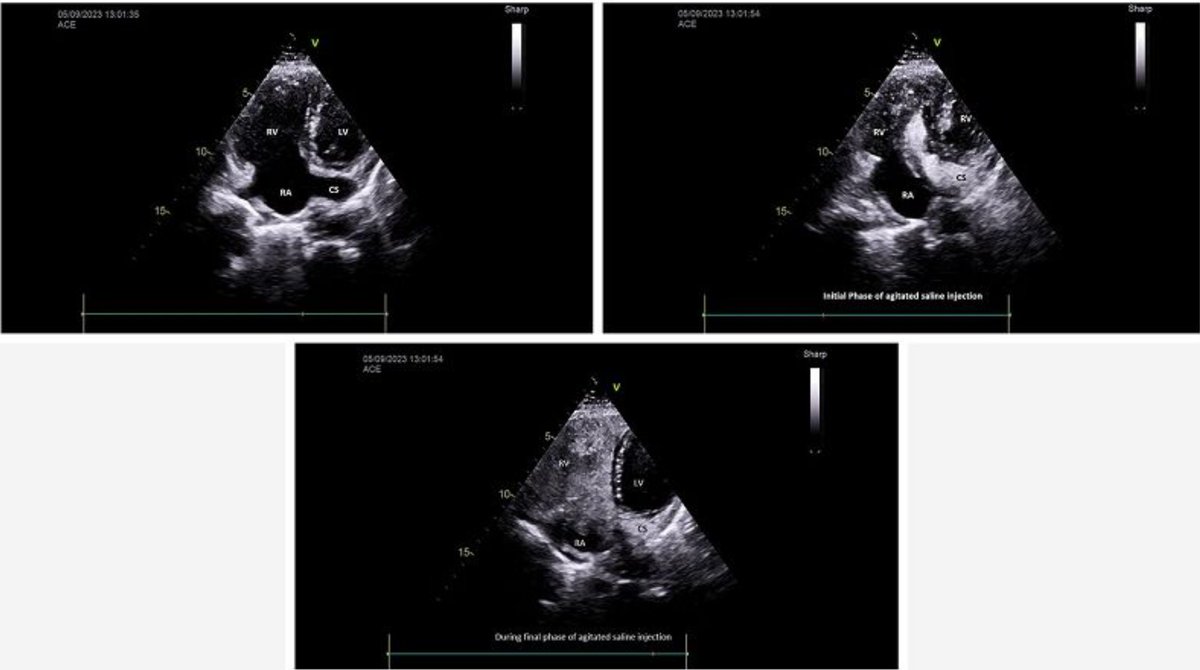 echo_stepbystep's tweet image. #ImageoftheWeek This #Quiz  was submitted by Bishal KC, Samir Gautam and Sachin Dhungel from the Gautam Buddha Community Heart Hospital, Butwal,🇳🇵
What does this agitated saline contrast echocardiography via left cubital vein show? 
☑️shorturl.at/NRTmn
@EACVIPresident