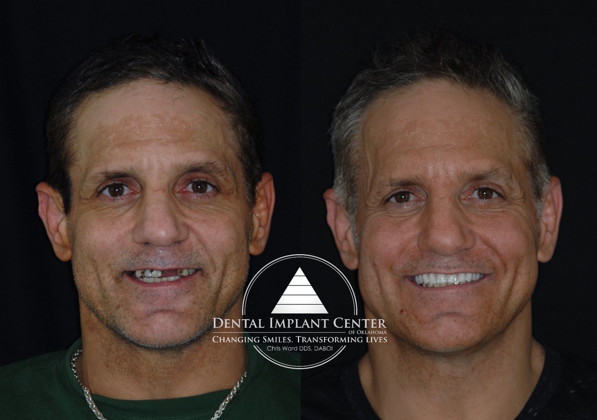 TulsaTeeth's tweet photo. Upper arch restoration with all-on-four dental implants in Tulsa, Oklahoma. No more hiding. 😎
Changing smiles. Transforming lives.

🌎 https://t.co/whosL7pPhX

#Wednesday #transformation  #smilemakeover #allonfour #tulsa #Oklahoma #dentalimplants #beforeandafter #fourstrong https://t.co/2c8e3Knjy2