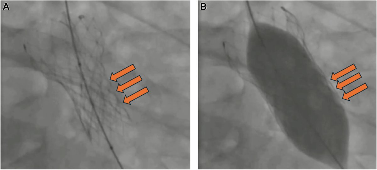MyJSCAI (@myjscai) on Twitter photo 📑Strategic Management of Valve Infolding in Evolut #TAVR Procedures
💡a case involving a 78yr man w symptomatic severe aortic valve stenosis.
➡️doi.org/10.1016/j.jsca…
<a href="/chadialraies/">Chadi Alraies, MD FACC FSCAI</a> <a href="/RajendraPShahMD/">Rajendra P Shah 🫀</a> @DrBAIMS <a href="/yaseminbaharr/">Yasemin Bahar, MD</a> <a href="/timir_paul/">Timir Paul, MD, PhD, FACC, FSCAI, FAHA</a> <a href="/RNarayanMD/">Rajeev L. Narayan, MD</a> 📑Strategic Management of Valve Infolding in Evolut #TAVR Procedures
💡a case involving a 78yr man w symptomatic severe aortic valve stenosis.
➡️doi.org/10.1016/j.jsca…
<a href="/chadialraies/">Chadi Alraies, MD FACC FSCAI</a> <a href="/RajendraPShahMD/">Rajendra P Shah 🫀</a> @DrBAIMS <a href="/yaseminbaharr/">Yasemin Bahar, MD</a> <a href="/timir_paul/">Timir Paul, MD, PhD, FACC, FSCAI, FAHA</a> <a href="/RNarayanMD/">Rajeev L. Narayan, MD</a>